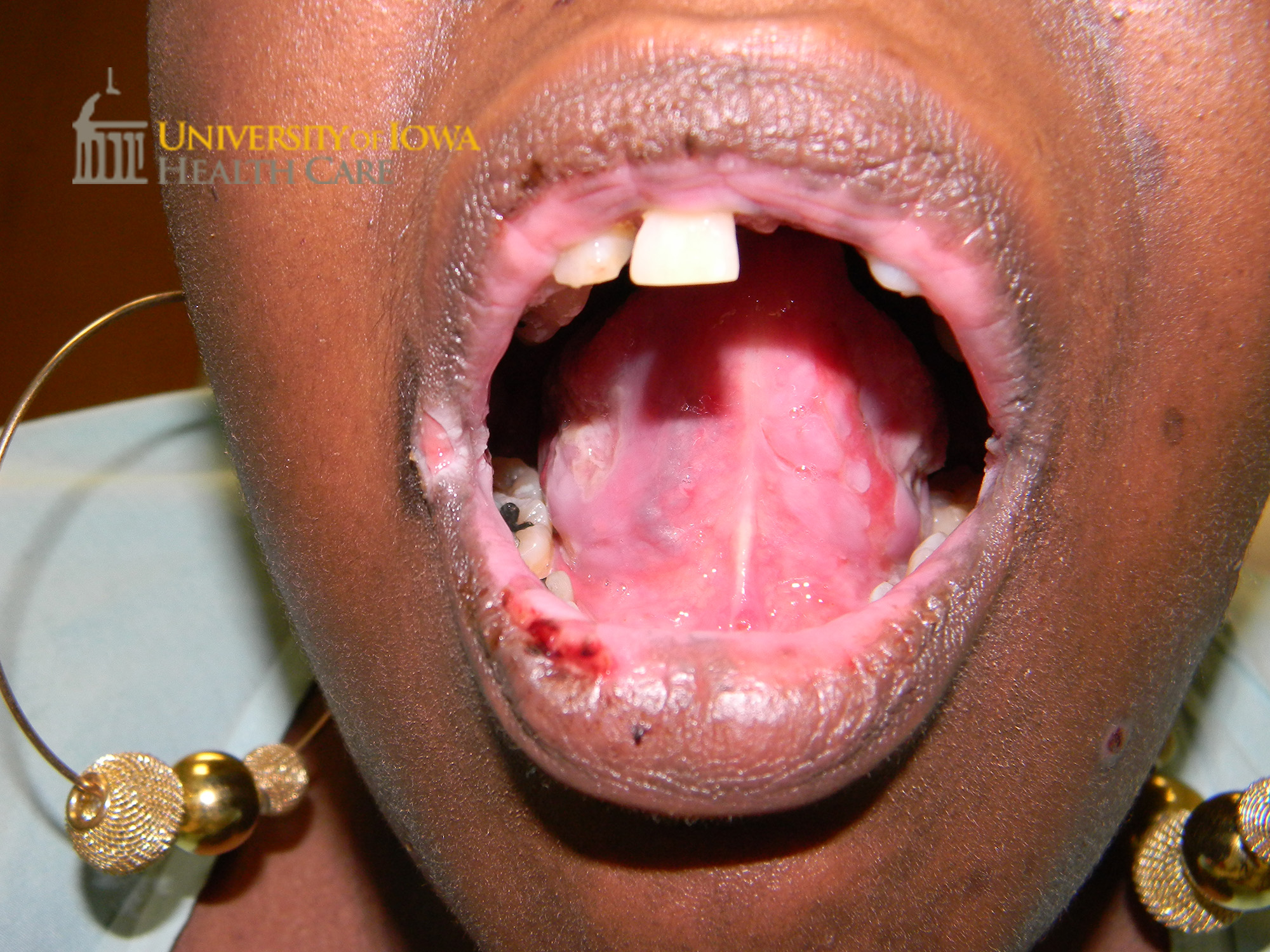 Superficial erosions on the mucosal lip and oral mucosa. (click images for higher resolution).